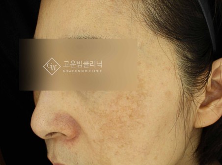 색소레이저를 여러 번 받아도 다시 올라오는 이유